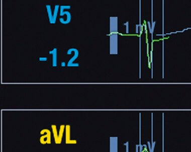 12-lead ST Monitoring