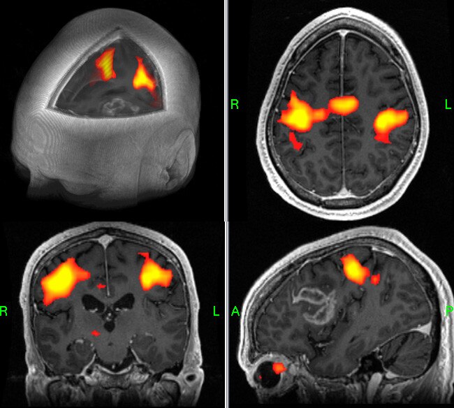 Brainwave de GE Healthcare