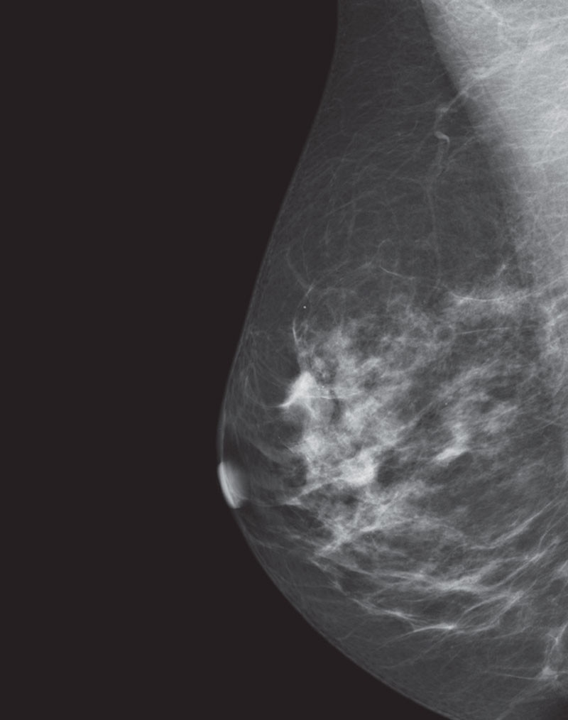 es-mammography-mammography-new-seno-claire-senoclaire_breast-imaging-sensitivity-case1.jpg
