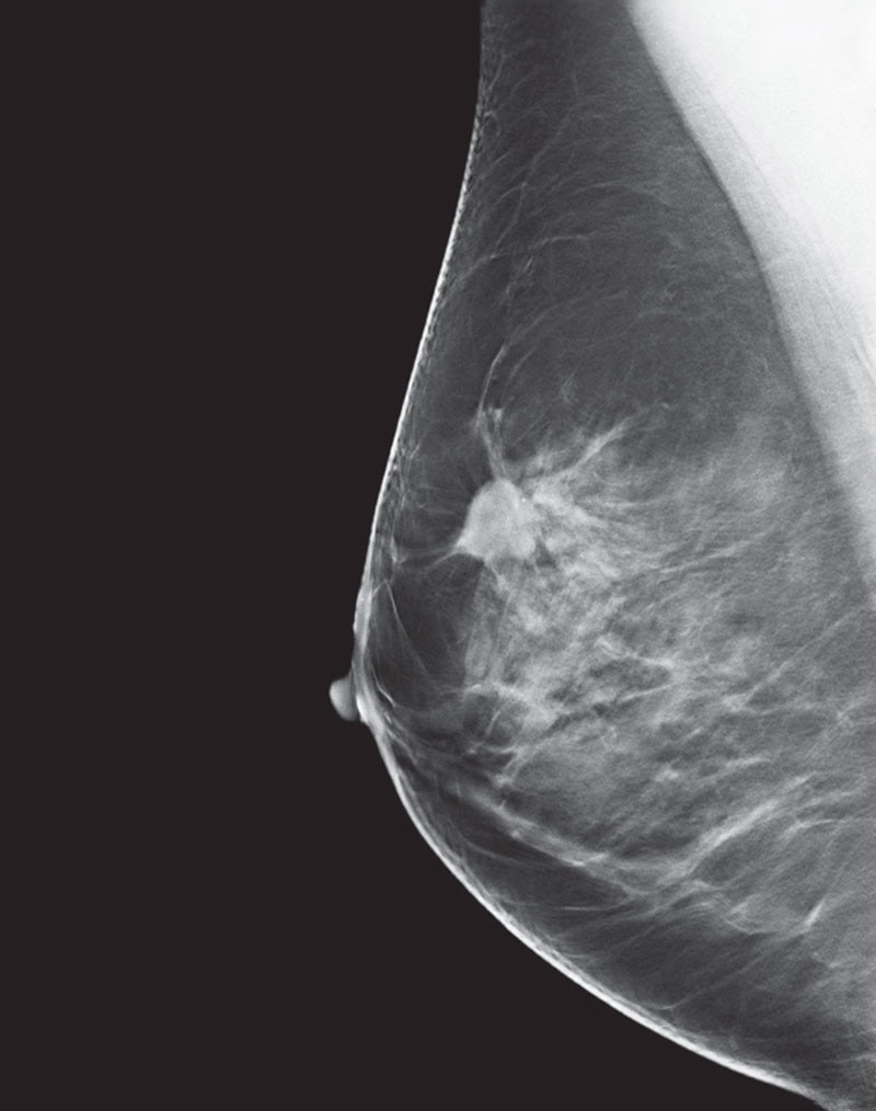 es-mammography-mammography-new-seno-claire-senoclaire_breast-imaging-sensitivity-case2.jpg