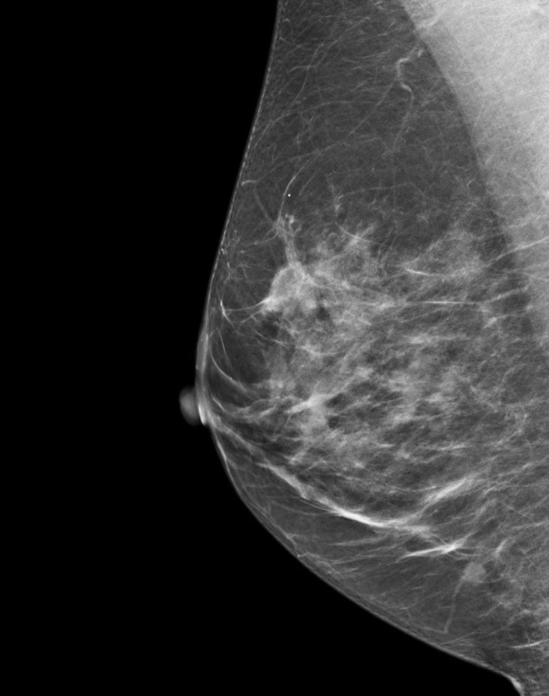 es-mammography-mammography-new-seno-claire-senoclaire_breast-imaging-sensitivity-case3.jpg